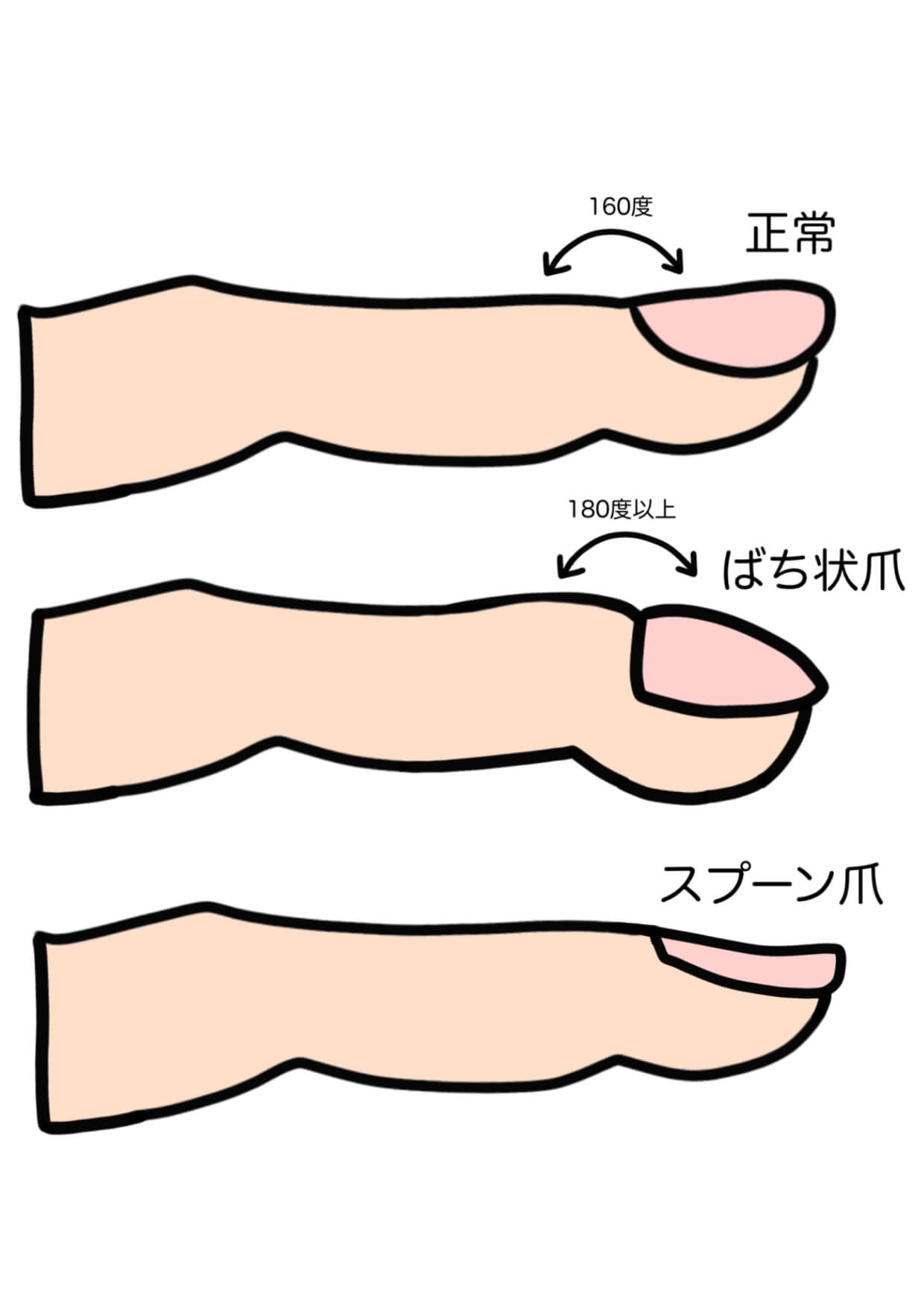 ばち状指看護, ばち状指とは 画像 – QJWRP
